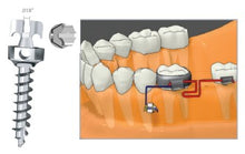 Load image into Gallery viewer, Micro implant (BH1413-06)
