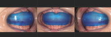 Load image into Gallery viewer, Pre-Ortho Type3 (Small-Soft)
